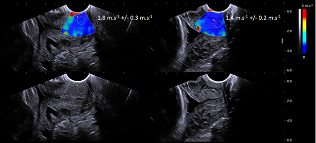 Ultrasounds may be used to detect signs of preterm labor