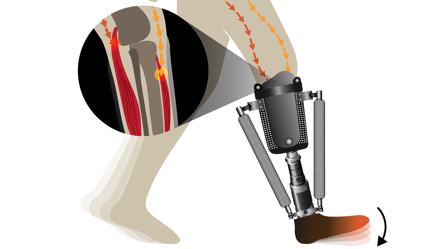 Illustration of ankle prosthetic.