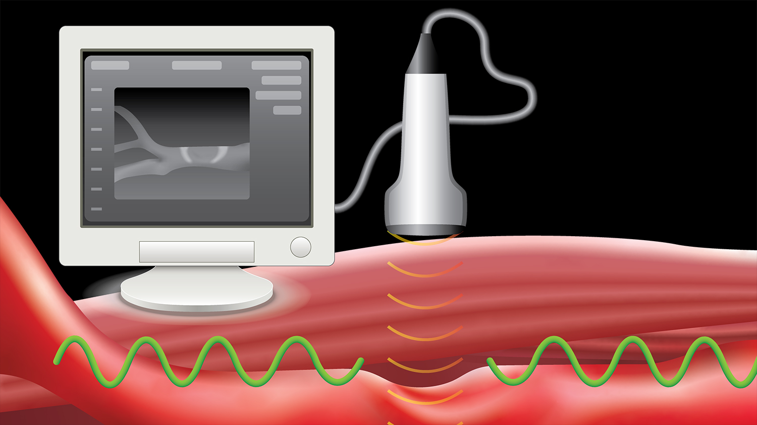 In this illustration, an ultrasound transducer sends a wave that pushes against arterial walls and records the wave propagation.