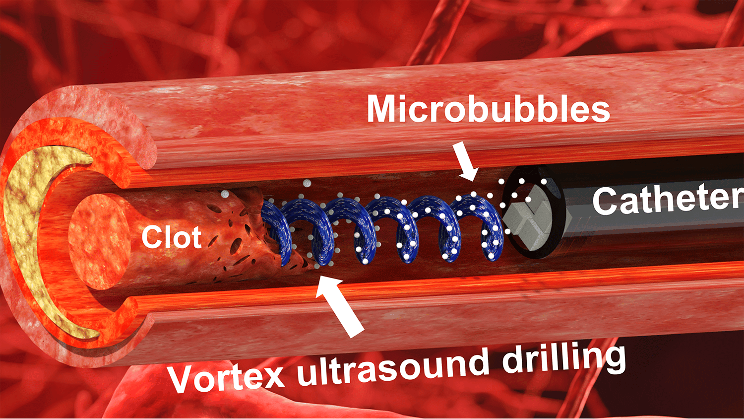 Illustration shows cross-section of a clogged blood vessel, with blue lines representing the vortex ultrasound clearing the clot.